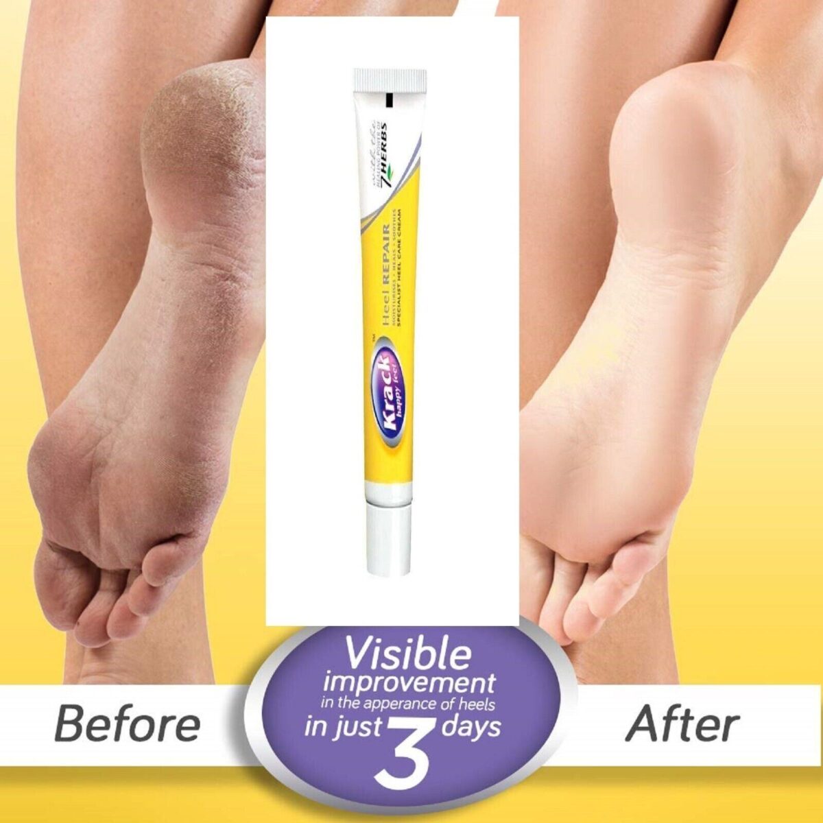 Krack Heel Repair Ayurvedic Foot Care Cream (25 Gm x 2) - Image 2