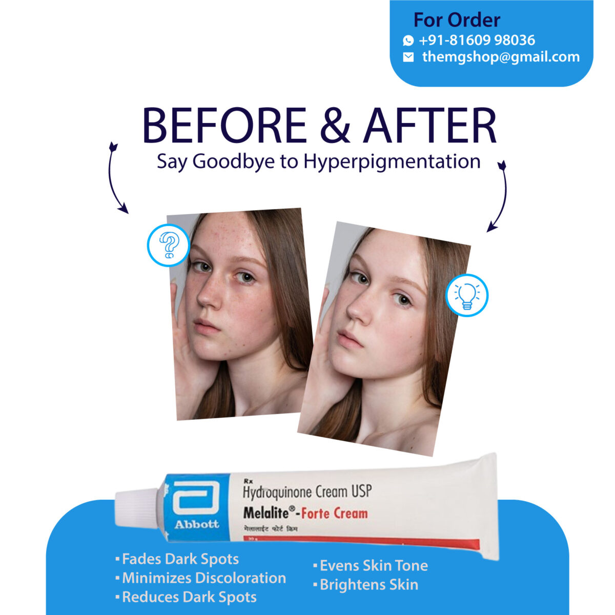 Melalite Forte Cream (30gm) Hydroquinone (4% w/w) lighten the areas of darkened skin such as chloasma, melasma, freckles, age spots and acne scars - Image 1